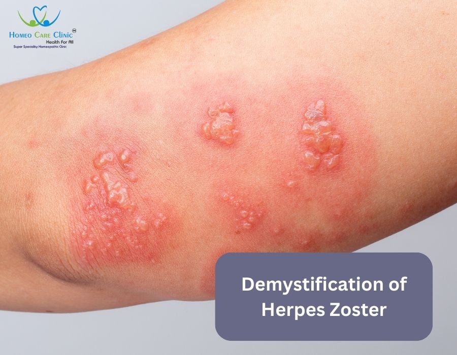 Demystification of Herpes Zoster From Painful Rash to Natural Relief with Homeopathy