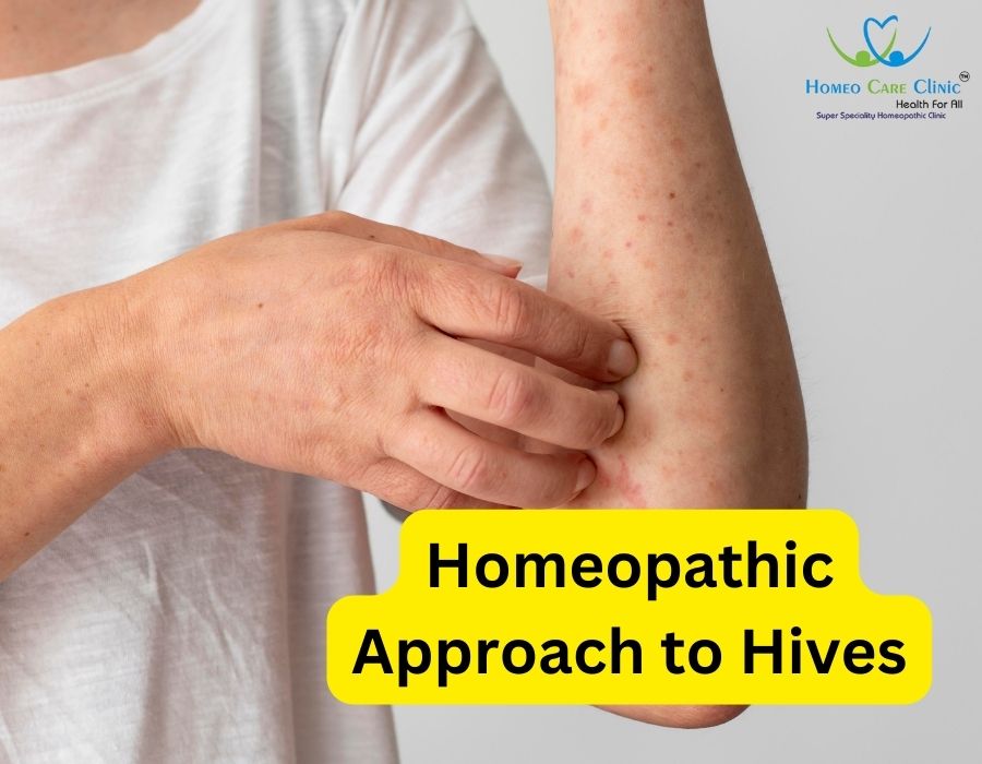 Homeopathic medicines for hives and skin rash relief
