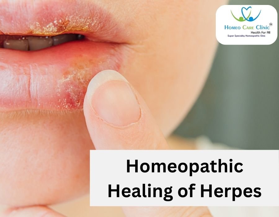 Homeopathic Healing of Herpes | Dr. Vaseem Choudhary
