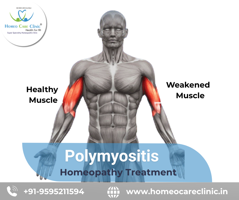 Homeopathic treatment for polymyositis muscle weakness