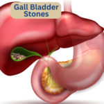 gall-bladder-stone