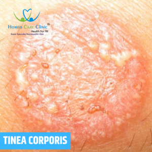 Homeopathic medicine and skin showing red circular ringworm rash