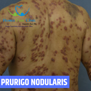 Prurigo nodularis homeopathy treatment