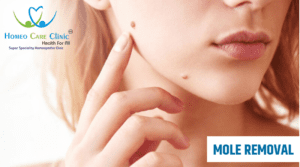 Mole Removal