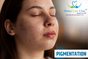 Treatment Options for Skin Pigmentation Problems