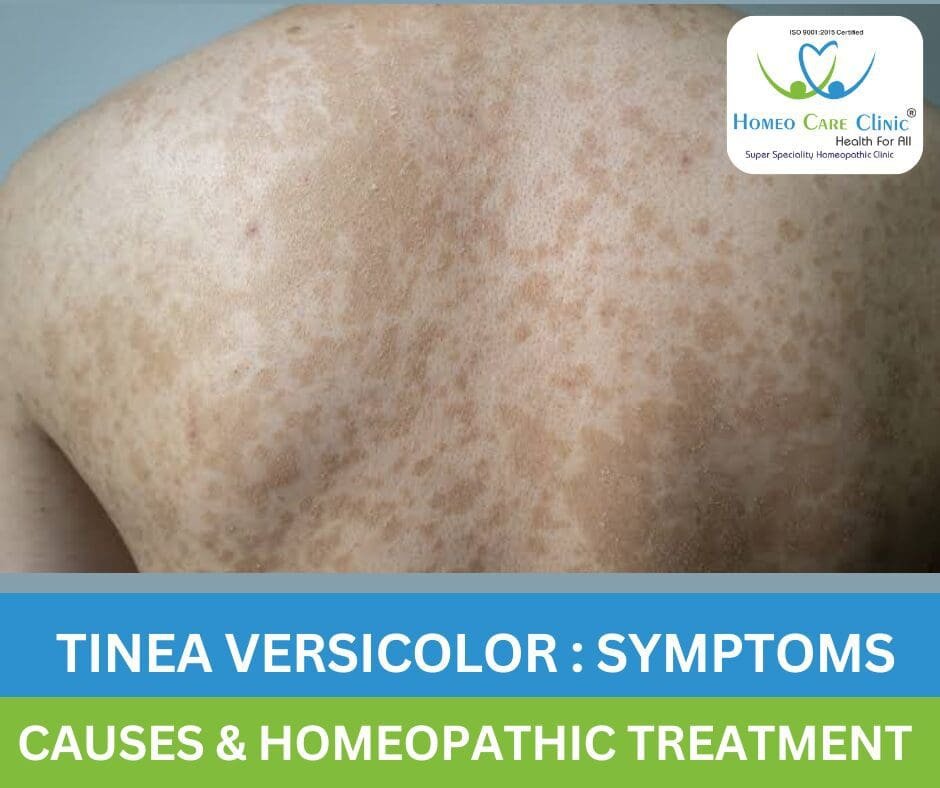 Tinea Versicolor Homeopathic Medicine