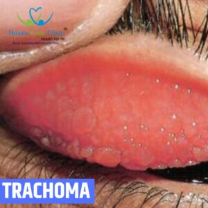 TRACHOMA