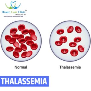 Child receiving homeopathic care for thalassemia support