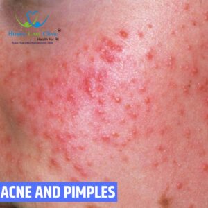 ACNE AND PIMPLES