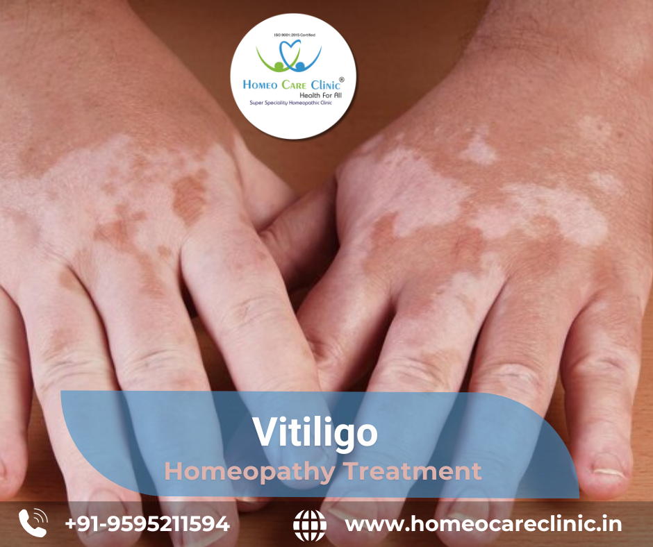 Homeopathic remedies for treating vitiligo white skin patches