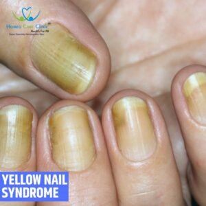 yellow-naikl-syndrome