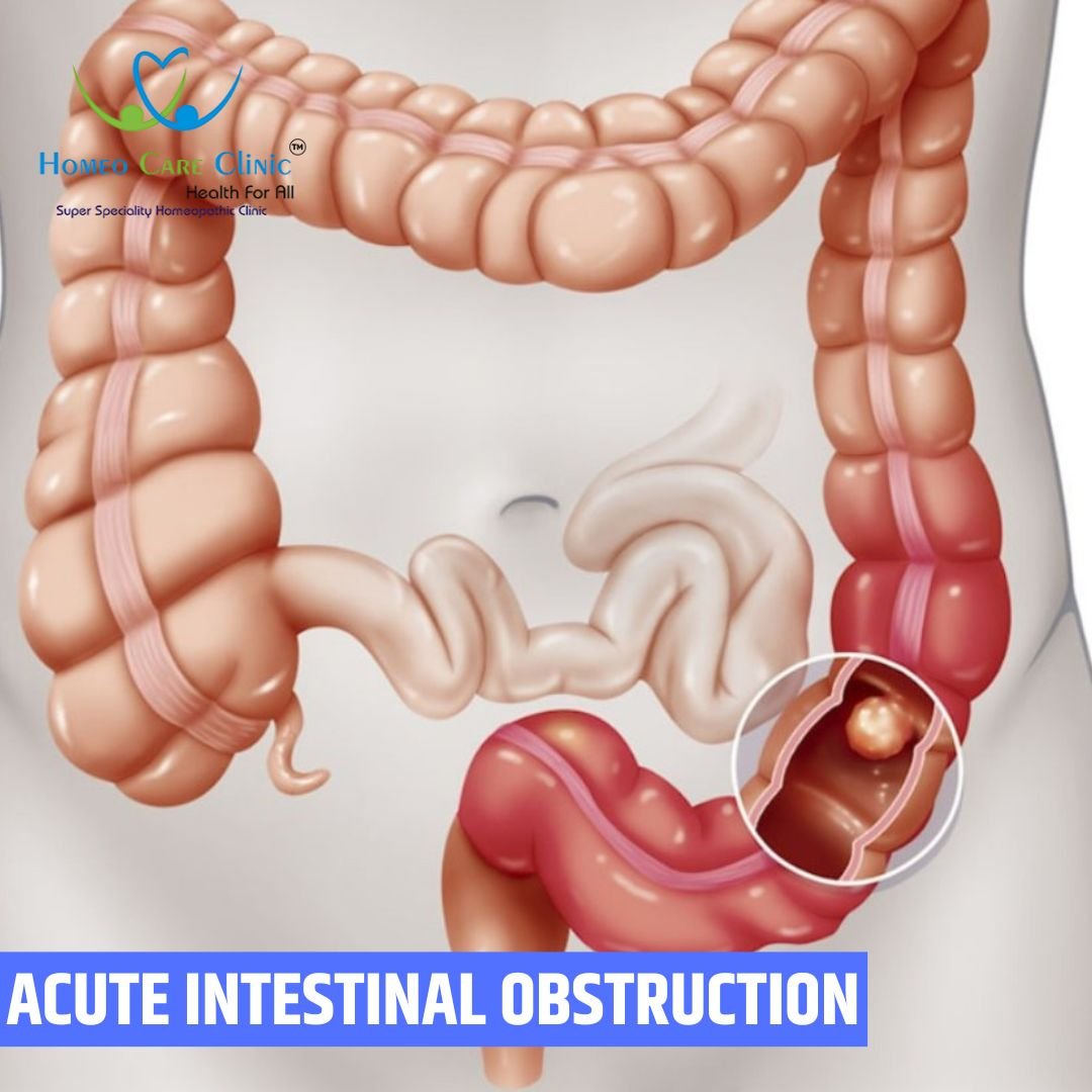 acute-intestinal obstruction