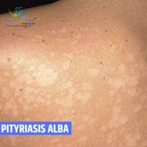 Pityriasis Alba Causes Symptoms Homeopathic Treatment Homeo Care pityriasis-alba-causes-symptoms-homeopathic-treatment-homeo-care