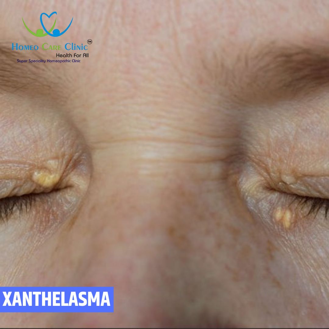 xanthelasma