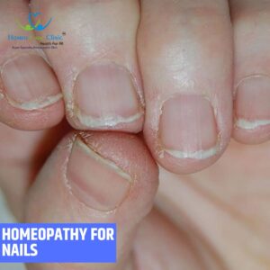 Homeopathy for nail health