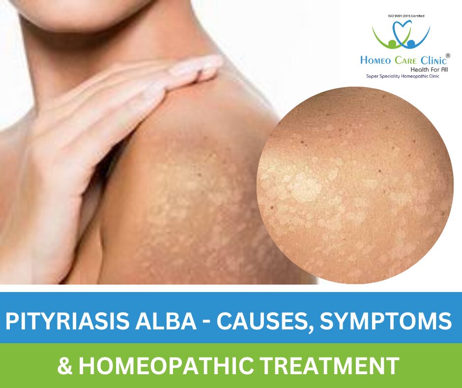 Skin with lighter patches caused by Pityriasis Alba