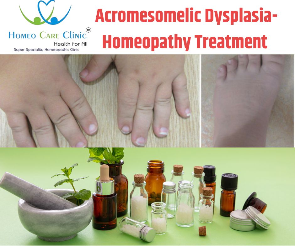 Acromesomelic Dysplasia Homeopathy Treatment