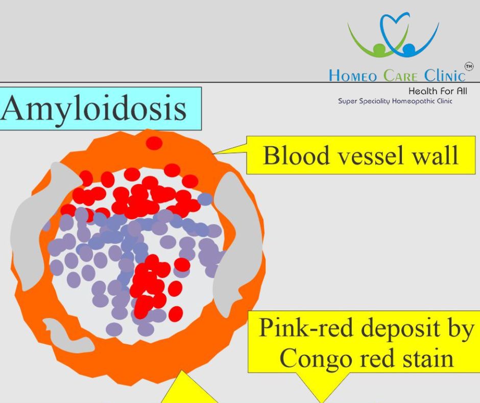 Amyloidosis Homeopathic Treatment Guide