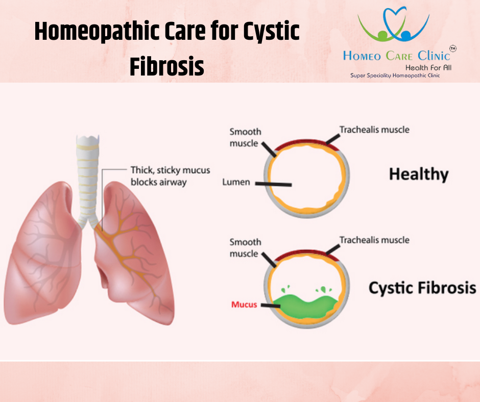 Homeopathic Care for Cystic Fibrosis