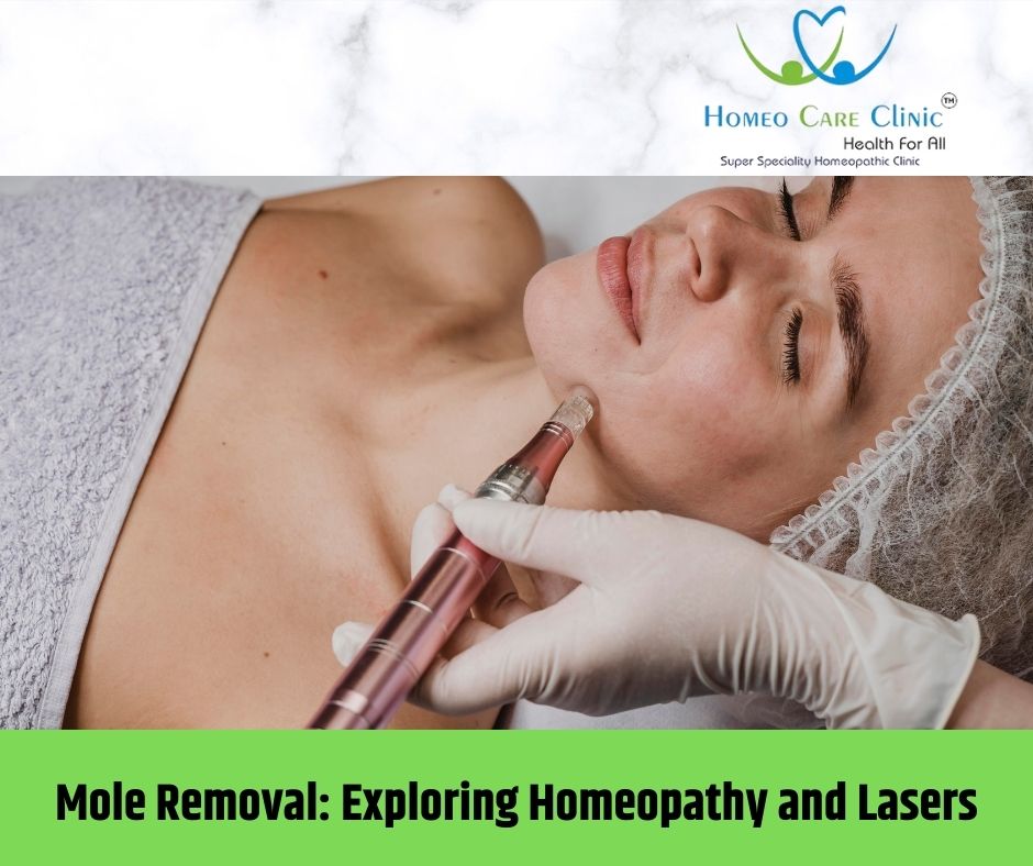 Person comparing laser mole removal and homeopathy treatment options