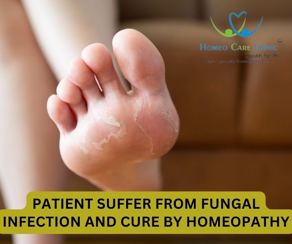 PATIENT SUFFER FROM FUNGAL INFECTION AND CURE BY HOMEOPATHY