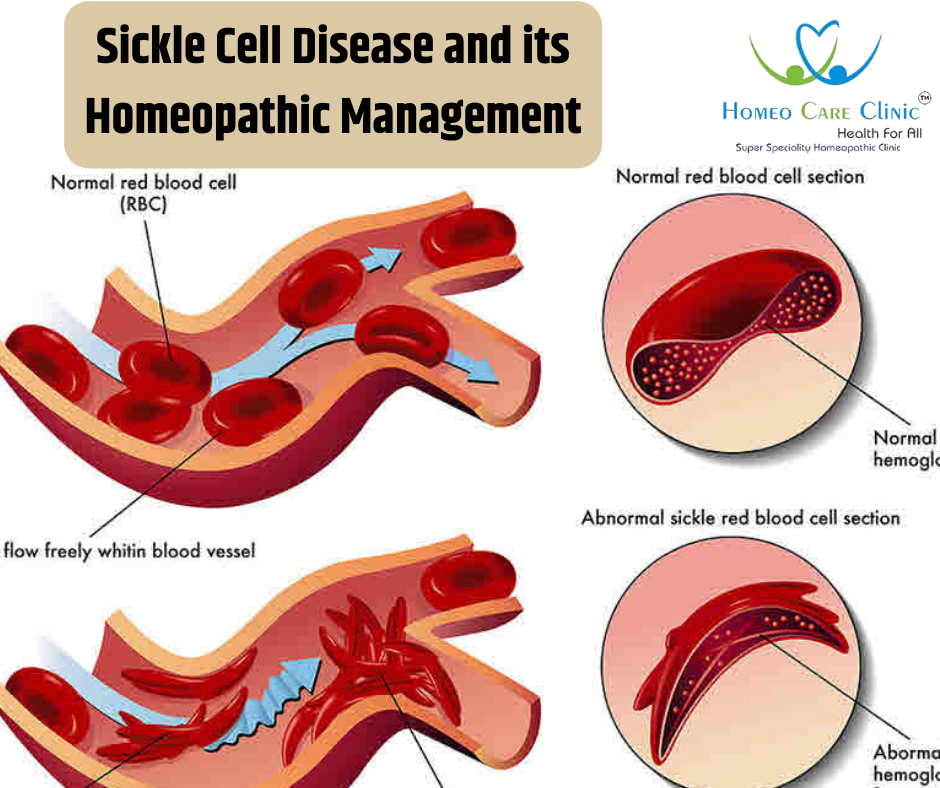 Sickle Cell Disease Homeopathic