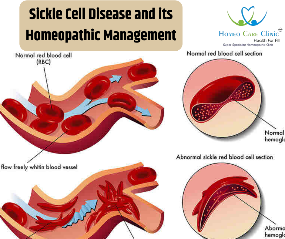 Sickle Cell Disease and its Homeopathic Management