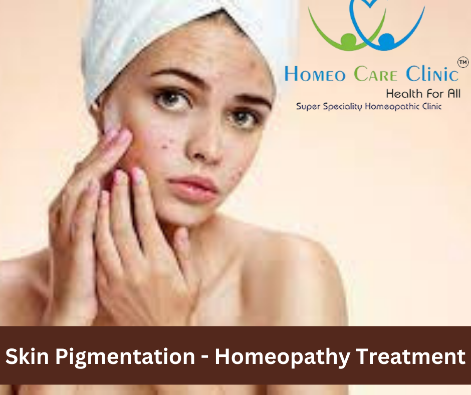 Skin Pigmentation for Homeopathy Treatment