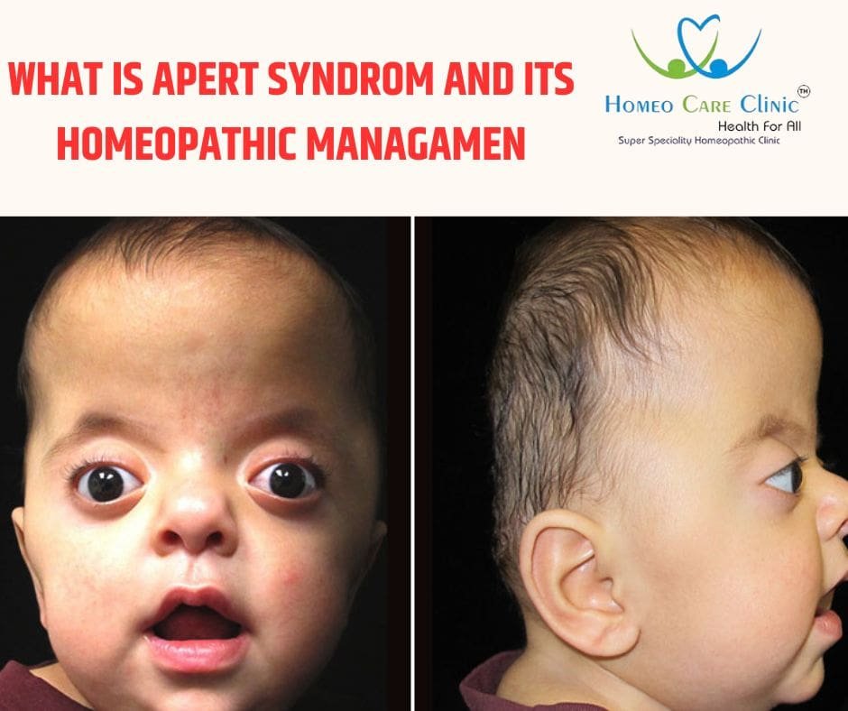 Apert Syndrome Causes Treatments Symptoms And More