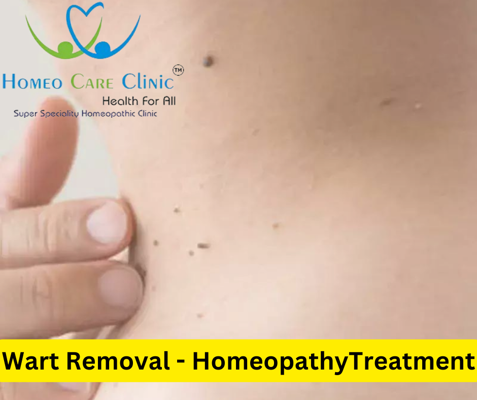 Wart Removal Homeopathy Treatment