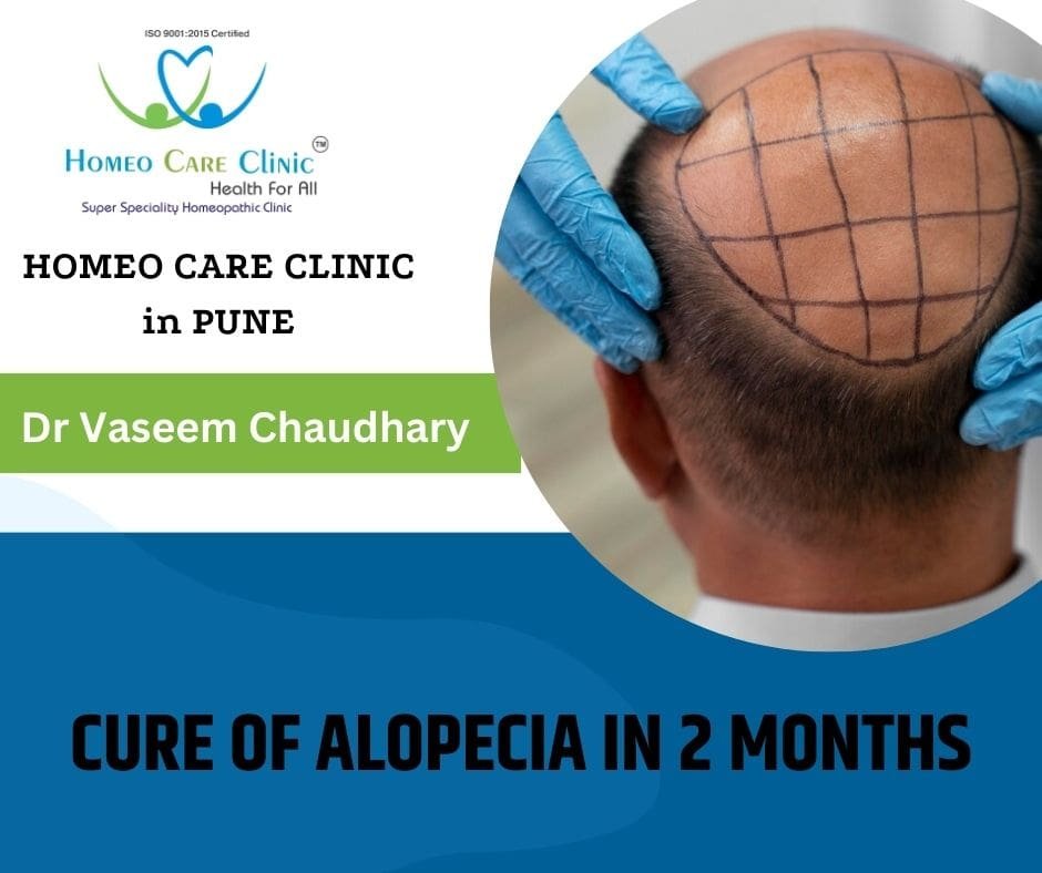 Homeopathic treatment for alopecia areata showing hair regrowth on a young male's scalp