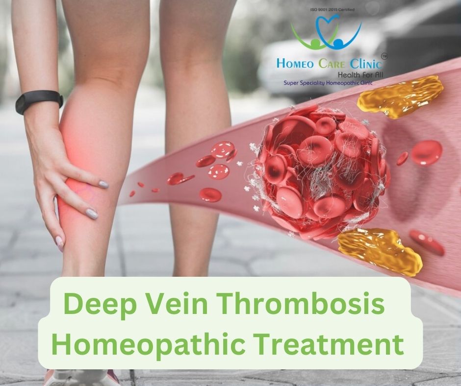 Deep Vein Thrombosis & Its Homeopathic Approach