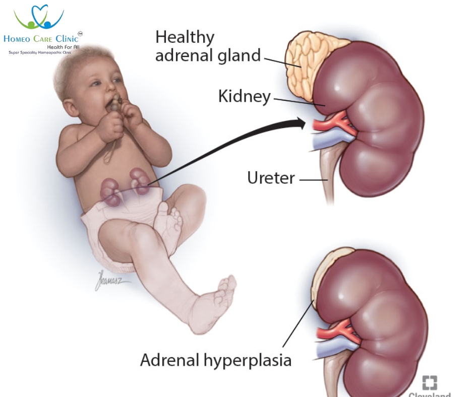 Homeopathic Tratment for Adrenal Hyperplasia