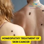 homeopathy treatment of skin cancer
