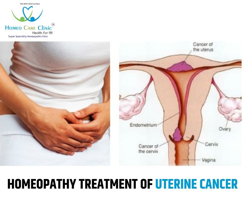 Homeopathic treatment of uterine cancer