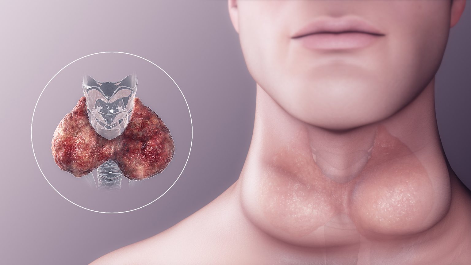 HYPOTHYROID Thyroid Treatment