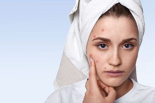 Acne-Pimples-Treatment-1 Acne/ Pimples Treatment