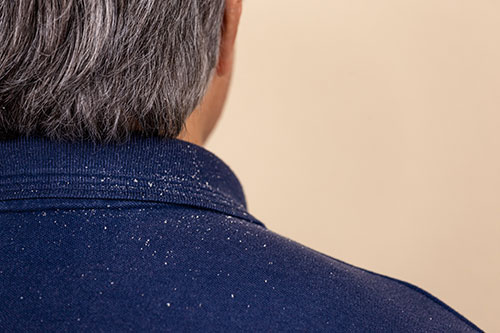Dandruff-treatment (1) White hair Removal