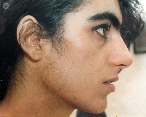 Thick unwanted Hair