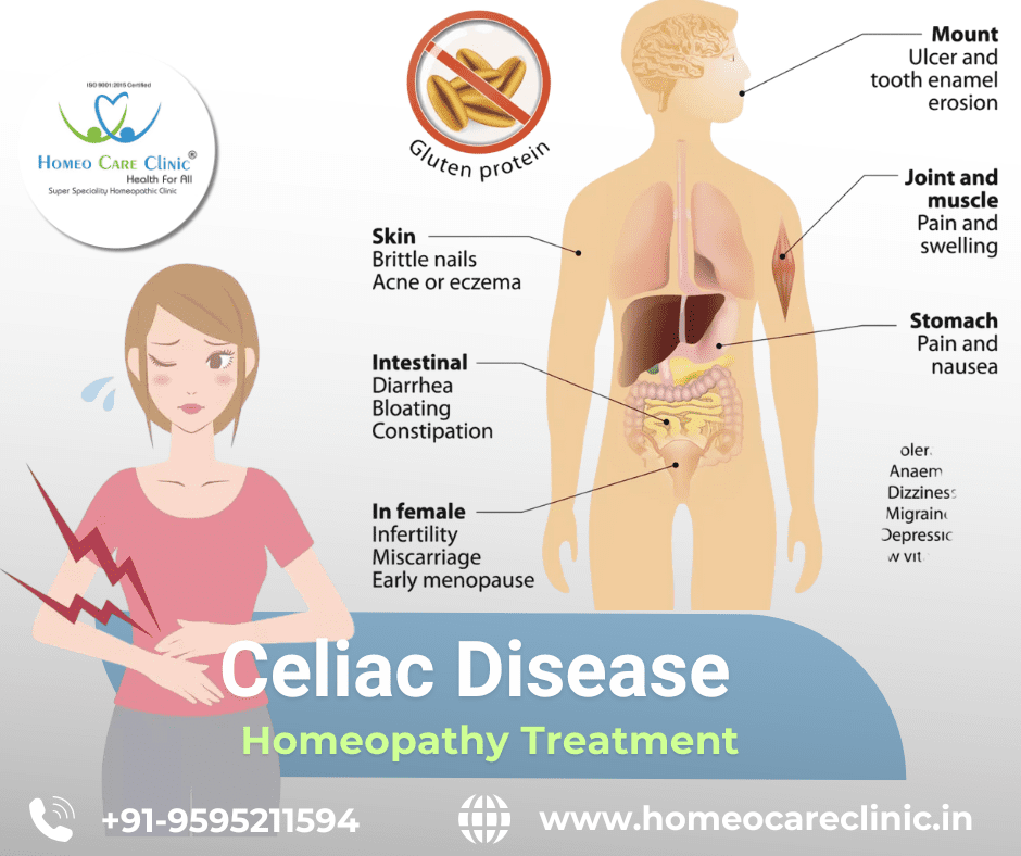 Picture of Celiac Disease: Causes, Symptoms, and Homeopathic Remedies