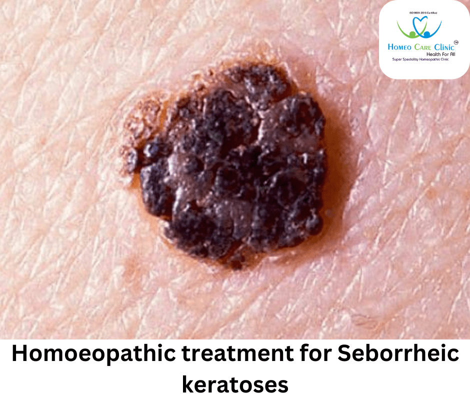 Natural Remedies For Seborrheic Keratosis Seborrheic Keratosis Laser Natural Remedies For Seborrheic Keratosis Seborrheic Keratosis Laser