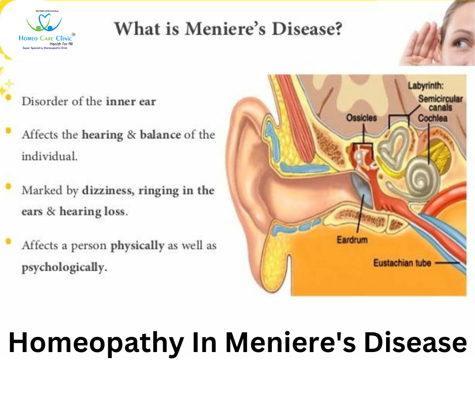 Homeopathic Treatment for Meniere’s