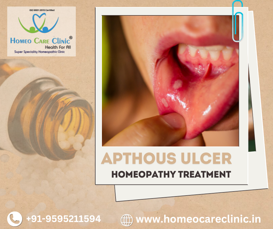 Homeopathic treatment for aphthous ulcers