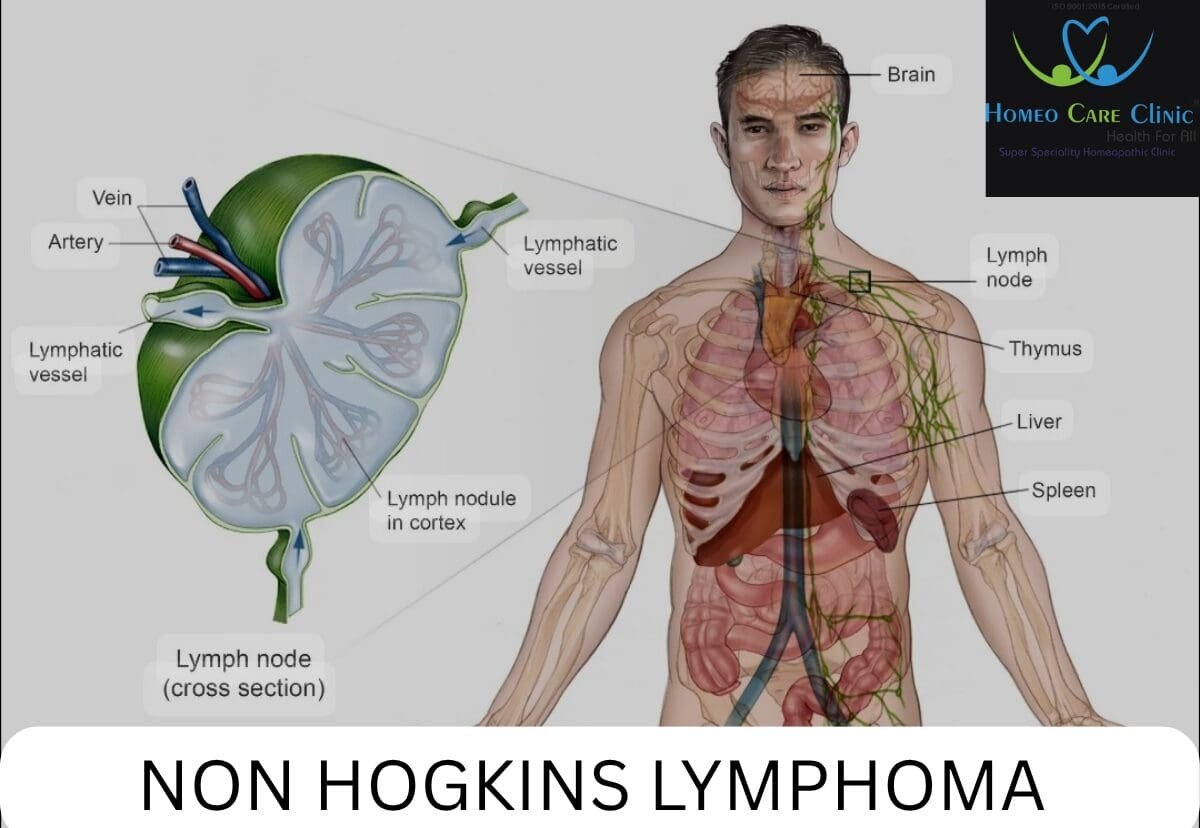 Non-Hodgkin’s Lymphoma