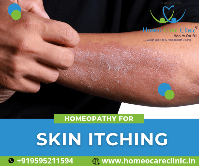 Best Homeopathic Treatment for Skin Itching Safe and Effective