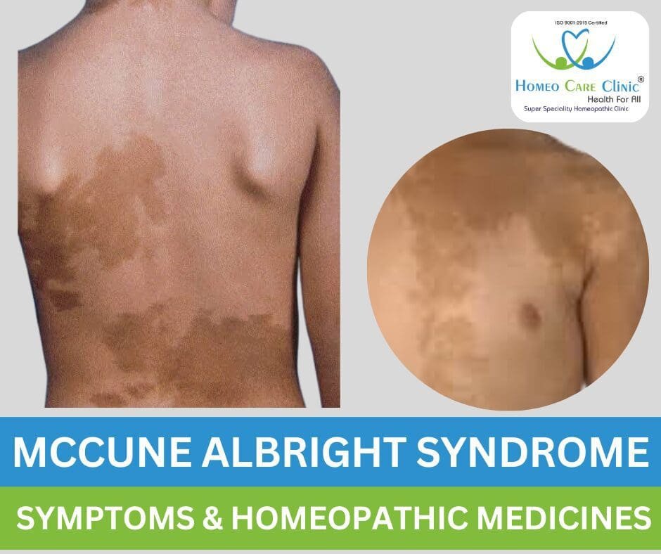 McCune-Albright syndrome treatment