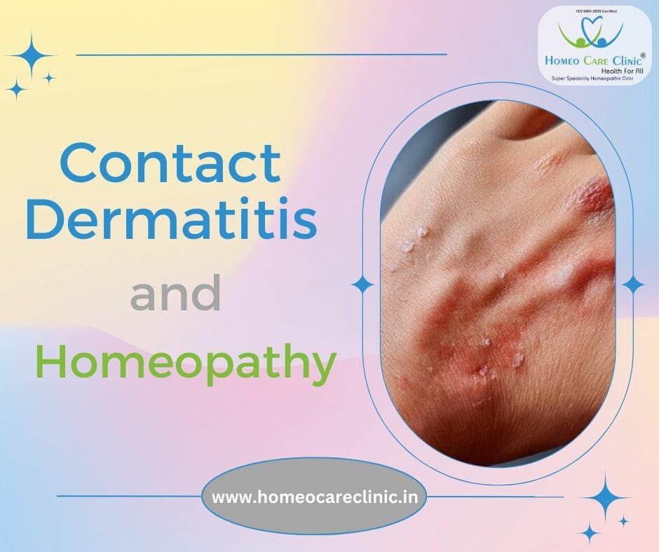 Contact Dermatitis Homeopathy Treatment