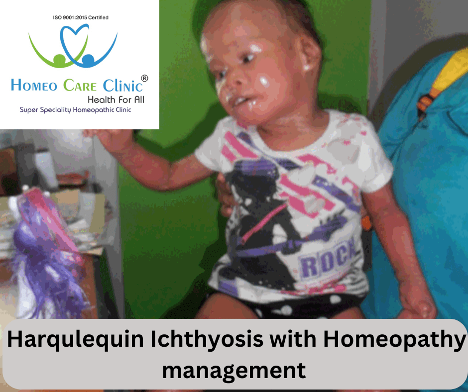 Harlequin Ichthyosis-affected skin.