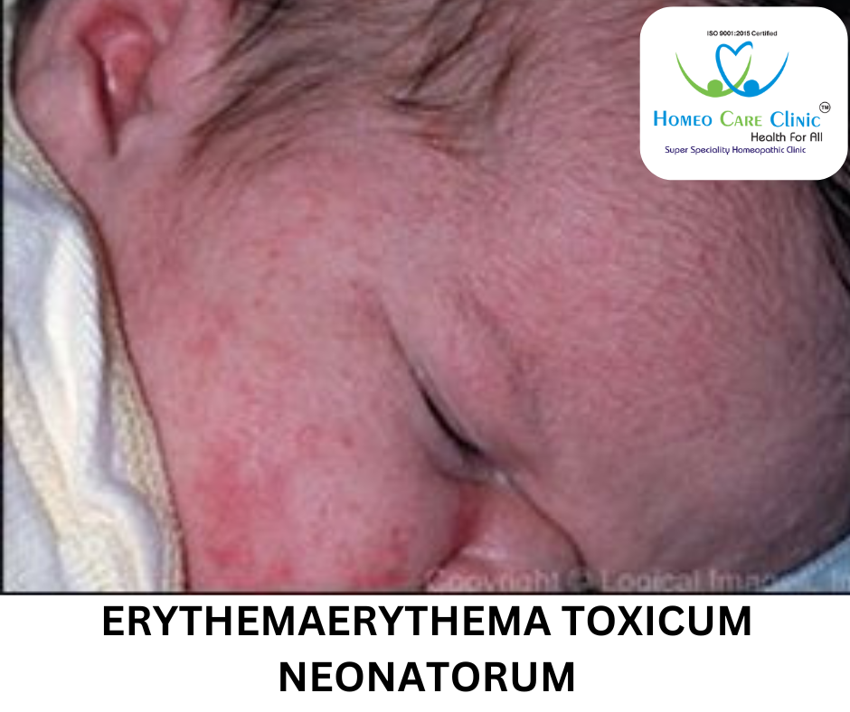 Erythema Toxicum Neonatorum symptoms