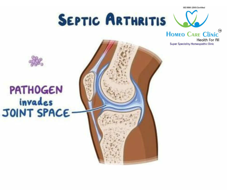 Homeopathic medicines for Septic Arthritis